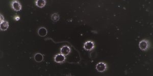 Dunkelfeld-Mikroskopie-Aufnahme von Blut, die stachelförmige, verformte rote Blutkörperchen (Echinozyten) und im Zentrum eine gewellte, fadenförmige Struktur zeigt, die typisch für Borrelien (Spirochäten) bei einer Borreliose-Infektion ist.