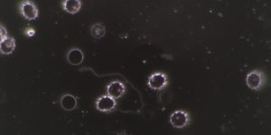 Dunkelfeld-Mikroskopie-Aufnahme von Blut, die stachelförmige, verformte rote Blutkörperchen (Echinozyten) und im Zentrum eine gewellte, fadenförmige Struktur zeigt, die typisch für Borrelien (Spirochäten) bei einer Borreliose-Infektion ist.