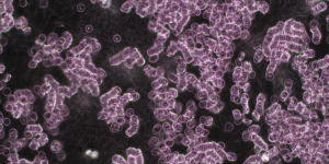 Dunkelfeld-Mikroskopie-Aufnahme von Blut, die eine starke Verklumpung der roten Blutkörperchen in Rouleaux-Formationen zeigt. Zwischen den Zellen ist ein dichtes Netzwerk von fibrillären Strukturen (Filznestern) sichtbar, was auf oxidativen Stress und chronische Entzündungen hinweist.