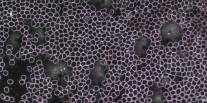 Dunkelfeld-Mikroskopie-Aufnahme von Blut, die eng aneinanderliegende, stark verformte rote Blutkörperchen (Filizellen/Akanthozyten) zeigt, mit deutlichen Clustern von fibrillären Strukturen (Filznestern) und aggregierten Zellen, interpretiert als Anzeichen für starken oxidativen Stress und chronische Entzündungen.