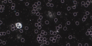 Dunkelfeld-Mikroskopie-Aufnahme von Blut, die zahlreiche rote Blutkörperchen (teilweise stachelig verformte Echinozyten) zeigt, eine helle Zelle (wahrscheinlich ein Granulozyt) und im Hintergrund fadenförmige und punktuelle Strukturen, die auf eine Pilzbelastung (Mykose) oder Hefen hinweisen können.