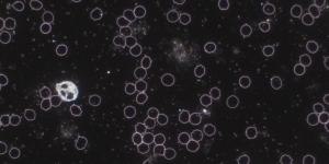 Dunkelfeld-Mikroskopie-Aufnahme von Blut, die zahlreiche rote Blutkörperchen (teilweise stachelig verformte Echinozyten) zeigt, eine helle Zelle (wahrscheinlich ein Granulozyt) und im Hintergrund fadenförmige und punktuelle Strukturen, die auf eine Pilzbelastung (Mykose) oder Hefen hinweisen können.