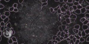Dunkelfeld-Mikroskopie-Aufnahme von Blut, die im Zentrum eine sehr große, dichte Ansammlung von Blutplättchen (Thrombozyten-Aggregation) zeigt, umgeben von eckigen roten Blutkörperchen (Echinozyten). Dies kann im Kontext von Riesenthrombozyten oder einer Gerinnungsstörung stehen.