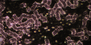 Dunkelfeld-Mikroskopie-Aufnahme des Blutes, die eine starke Aggregation der roten Blutkörperchen in langen Stapeln (Rouleaux-Bildung) zeigt, umgeben von vielen kleinen, hell leuchtenden Partikeln, die im Kontext einer Schwermetallbelastung interpretiert werden.