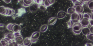 Mikroskopaufnahme des Blutes mit violett gefärbten roten Blutkörperchen, die teilweise normal und teilweise stark verformt in der Form von sogenannten Zitronenzellen (Leberbelastung) oder Ovalozyten erscheinen.